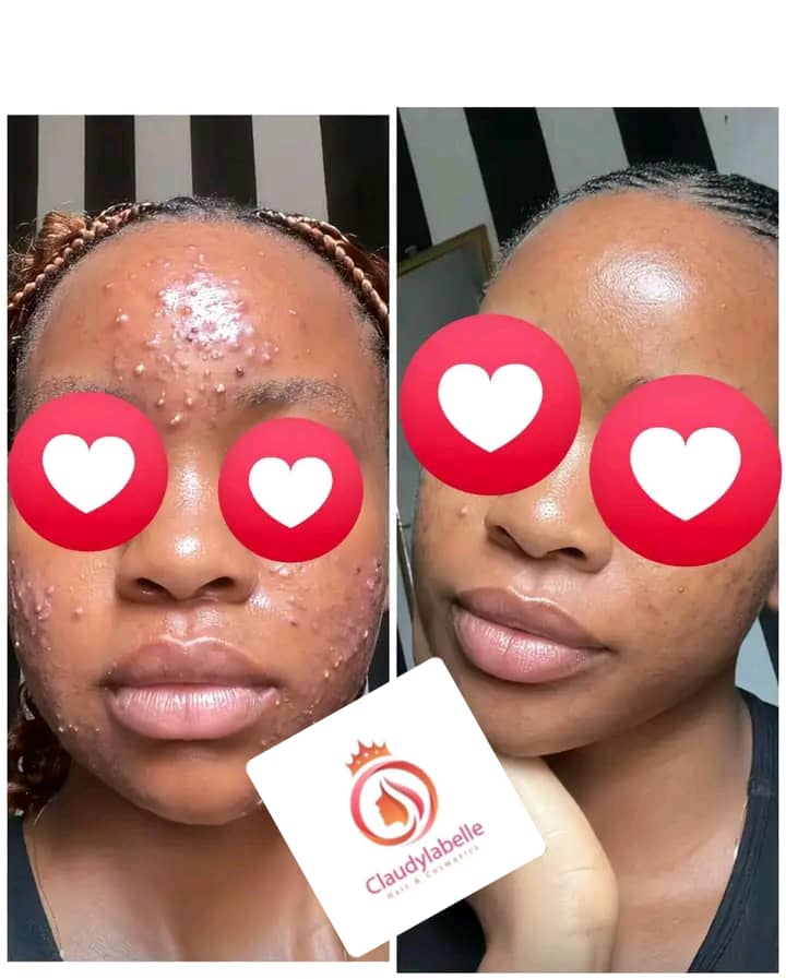 Gamme acné/visage propre